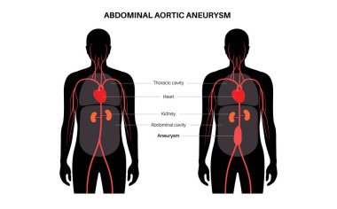 Abdominal aort anevrizması ve insan vücudunda sağlıklı aort. Karın bölgesinin alt kısmında yüksek tansiyon veya iltihap var. Tıbbi diyagram, insan vasküler anatomi vektörü çizimi