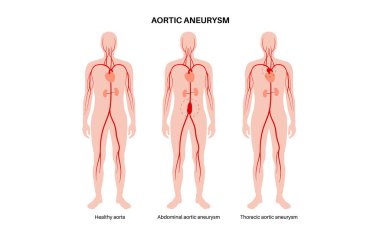 Abdominal Aort Anevrizması, Torasik Aort Anevrizması ve sağlıklı aort. Göğüste ve karnının alt kısmında yüksek tansiyon var. Tıbbi diyagram, vasküler anatomi vektör çizimi.