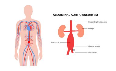 İnsan vücudunda abdominal aort anevrizması. Karın aortunda yüksek tansiyon. Karın bölgesinde iltihaplanma var. Tıbbi diyagram, insan vasküler anatomi vektörü çizimi