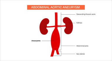 Abdominal aort anevrizması infografik poster. Karın aortunda yüksek tansiyon. Karın bölgesinde iltihaplanma var. Tıbbi diyagram, insan vasküler ve böbrek anatomisi çizimi