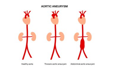 Abdominal Aort Anevrizması, Torasik Aort Anevrizması ve sağlıklı aort. Göğüste ve karnının alt kısmında yüksek tansiyon var. Tıbbi diyagram, vasküler anatomi vektör çizimi.