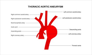 Torasik aort anevrizması bilgisi. Kalp rahatsızlığı. Ağrı, ekstra basınç, göğüste iltihap. Göğüs aortunun genişletilmiş kısmı. Tıbbi diyagram, genişlemiş kan damarları vektör çizimi