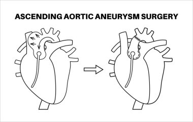 Torasik aort anevrizması açık ameliyat. Cerrah, genişlemiş aort bölümünü sentetik greftle onarıyor ya da değiştiriyor. Kardiyovasküler prosedür, aort onarımı, hastane operasyon vektör illüstrasyonu