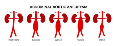 Abdominal aort anevrizmasının tipleri, konuma göre sınıflandırılmış. Suprarenal, subbrenal, pararenal ve infrarenal. İnsan kardiyovasküler anatomi diyagramı tıbbi poster düz vektör çizimi