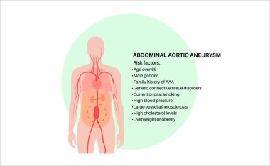 Abdominal Aort Anevrizması ana risk faktörleri posteri. Ağrı, yüksek tansiyon ya da karın bölgesinin alt kısmında iltihap. Tıbbi diyagram, insan vasküler anatomisi düz vektör çizimi