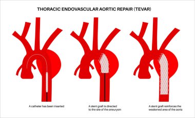 Torasik aort anevrizmasının minimum invaziv onarımı. Torasik aortun içine stent grefti yerleştirmek için atardamardan kateter yerleştirilmiş. Endovasküler prosedür, kardiyovasküler müdahale tıbbi vektör
