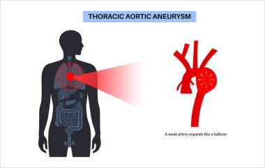 İnsan vücudunda torasik aort anevrizması. Ağrı, basınç ya da göğüste iltihap. Göğüs aortunun genişletilmiş kısmı. Genişlemiş kan damarları ile tıbbi diyagram düz vektör çizimi