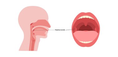 Orofarinks bölgesinde palatin bademcikler, dudaklar ve dişler için bilgi posteri. Palatoglossal ve palatofaringeal kemerler arasındaki ağız boşluğunda bademcikler var.