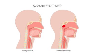 Nazofarenks tıbbi posterinde büyümüş adenoidler var. Geniz yoluyla hava akışını engelleyen şişmiş lenfoid dokuyu gösteren bir çocuğun ya da yetişkinin kafasının yay görüntüsü.