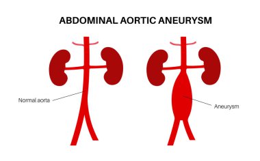 Abdominal aort anevrizması ve sağlıklı aort posteri. Ağrı, yüksek tansiyon ya da karın bölgesinin alt kısmında iltihap. Tıbbi diyagram, insan vasküler anatomisi düz vektör çizimi