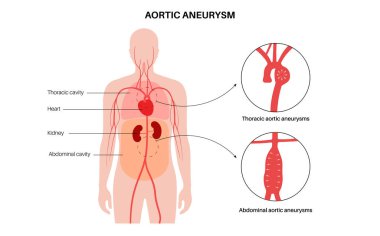 Abdominal Aort Anevrizması ve Torasik Aort Anevrizması. Göğüste ve karnının alt kısmında yüksek tansiyon var. Tıbbi diyagram, insan vasküler anatomisi düz vektör çizimi