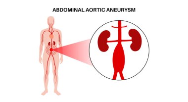 İnsan vücudunda abdominal aort anevrizması. Karın aortunda yüksek tansiyon. Karın bölgesinde iltihaplanma var. Tıbbi diyagram, insan vasküler anatomi vektörü çizimi