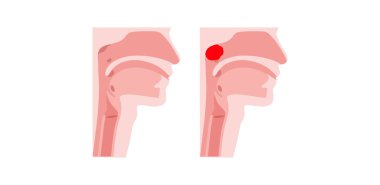 Nazofarenks tıbbi posterinde büyümüş adenoidler var. Geniz yoluyla hava akışını engelleyen şişmiş lenfoid dokuyu gösteren bir çocuğun ya da yetişkinin kafasının yay görüntüsü.