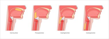 Yutkunmanın anatomisi. Kafası ve boynu, dili ve gırtlağı tıkayan yiyeceklerin yan görüntüsü. Damak zevki yükselmiş. Epiglot yemek borusuna giden yolu tıbbî illüstrasyon için kapatıyor.