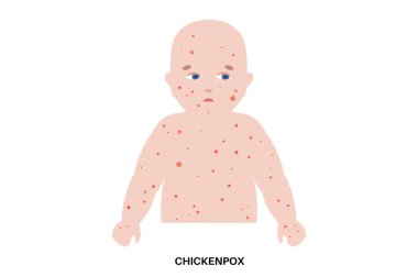 Varicella, suçiçeği, varicella zoster virüsü. Yüzünde, gövdesinde, kollarında ve bacaklarında kırmızı lekeler, papüller ve vazolar olan çocuk. Ateş ve kaşıntı. Viral çocukluk enfeksiyonları Tıbbi vektör