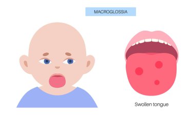 Macroglossia poster, abnormal oversized, enlargement of the tongue. Interfere with talking, chewing, breathing. Congenital or acquired problems, genetic disorders, or systemic diseases medical vector