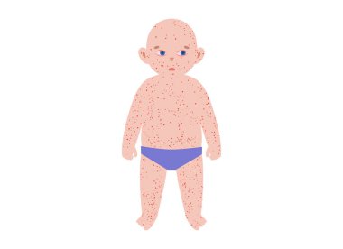 Çocuklarda görülen en yaygın isilik. Çoklu çocuk siluetleri, gövde, yüz, kol ve bacaklarda her hastalık için döküntü desenler var. Kızamık, rubeola, rubella, roseola. Çeşitli aşamalarda Vesiküler lezyonlar