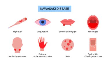 Kawasaki Hastalıkları posteri. Çocuklarda sınırlı vaskülit. Kırmızı çatlak dudaklar, çilek dili, konjonktival enjeksiyon, deri kızarıklığı, şişmiş eller ve ayaklar. Sistemik iltihaplanma düz vektör