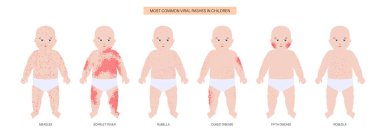 Çocuklarda görülen en yaygın isilik. Çoklu çocuk siluetleri, gövde, yüz, kol ve bacaklarda her hastalık için döküntü desenler var. Kızamık, rubeola, rubella, roseola. Çeşitli aşamalarda Vesiküler lezyonlar