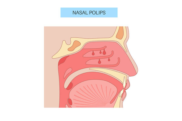Анатомический плакат Nasal Polyps. Доброкачественные мягкие образования в носовой полости, хроническое воспаление или инфекция. Анатомия носа с нераковыми полипами в носу, плоская векторная медицинская иллюстрация.