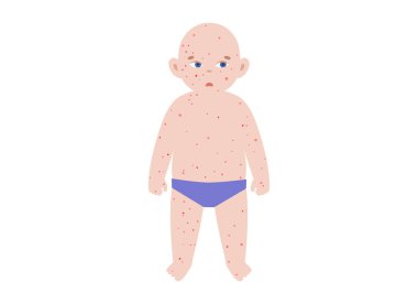 Çocuklarda görülen en yaygın isilik. Çoklu çocuk siluetleri, gövde, yüz, kol ve bacaklarda her hastalık için döküntü desenler var. Kızamık, rubeola, rubella, roseola. Çeşitli aşamalarda Vesiküler lezyonlar
