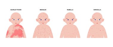 Çocuklarda görülen en yaygın isilik. Çoklu çocuk siluetleri, gövde, yüz, kol ve bacaklarda her hastalık için döküntü desenler var. Kızamık, rubeola, rubella, roseola. Çeşitli aşamalarda Vesiküler lezyonlar