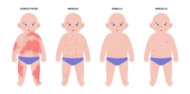 Çocuklarda görülen en yaygın isilik. Çoklu çocuk siluetleri, gövde, yüz, kol ve bacaklarda her hastalık için döküntü desenler var. Kızamık, rubeola, rubella, roseola. Çeşitli aşamalarda Vesiküler lezyonlar