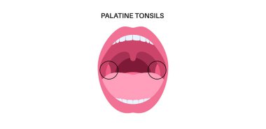 Orofarinks bölgesinde palatin bademcikler, dudaklar ve dişler için bilgi posteri. Palatoglossal ve palatofaringeal kemerler arasındaki ağız boşluğunda bademcikler var.