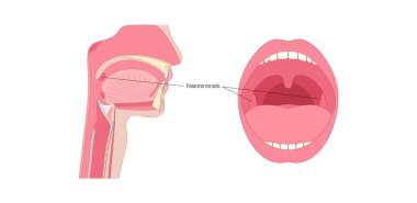 Orofarinks bölgesinde palatin bademcikler, dudaklar ve dişler için bilgi posteri. Palatoglossal ve palatofaringeal kemerler arasındaki ağız boşluğunda bademcikler var.
