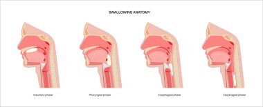Yutkunmanın anatomisi. Kafası ve boynu, dili ve gırtlağı tıkayan yiyeceklerin yan görüntüsü. Damak zevki yükselmiş. Epiglot yemek borusuna giden yolu tıbbî illüstrasyon için kapatıyor.