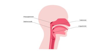 Bademcik anatomik tıbbi posteri. Oval şekilli lenfoid doku kütleleri insan boğazının arkasında bulunuyor. Ağızdan ya da burundan giren mikropları tuzağa düşürür..