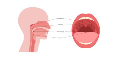 Adenoid tıbbi poster, farengeal bademcik, boğazın üst kısmında, burnun arkasında bulunan lenfoid doku yığını. Bağışıklık sistemi konsepti. Çocuklar sağlık tıbbi düz vektör çizimi.