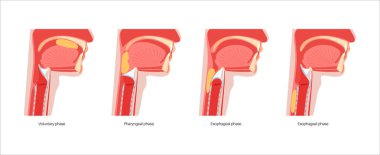 Yutkunmanın anatomisi. Kafası ve boynu, dili ve gırtlağı tıkayan yiyeceklerin yan görüntüsü. Damak zevki yükselmiş. Epiglot yemek borusuna giden yolu tıbbî illüstrasyon için kapatıyor.