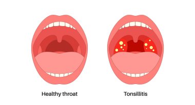 Bademcik iltihabı ve ağız anatomisi. Büyümüş, kızarıklık ve beyaz bantlı bademcikler. Boğaz dokusunu sarmış, şişmiş ve ateşle tahriş olmuş. Boğaz ağrısı vektör tıbbi çizim