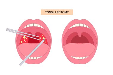 Bademcik ameliyatı posteri. Damar bademciklerinin anestezi altında ameliyatla alınması, boğaz anatomisini, ağzı ve düz vektör medikal illüstrasyon sırasında kullanılan aletleri gösteriyor.