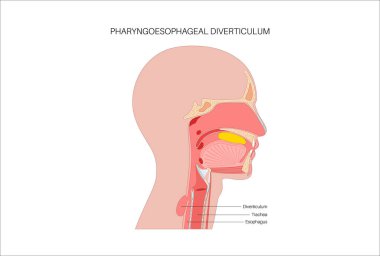 Pharyngoözofageal diverticulum medikal poster. Yemek borusu ve gırtlağı olan bir insan. Gırtlak ve yemek borusu kavşağındaki şişkinlik gibi bir kese. Divertikulum vektörünün içinde kapana kısılmış yiyecekler