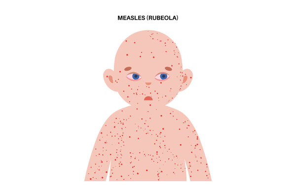 Measles or rubeola symptoms. Child with a high fever, widespread red rash starting at the hairline and spreading downward. Koplik spots in the mouth, conjunctivitis, cough, and runny nose vector