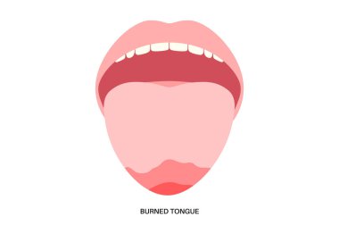 Yanmış dil, kırmızı, iltihaplı ve şişmiş yüzey termal yaralanma belirtileri gösteriyor. Sıcak yemek ya da içeceklerden kaynaklanan hasar. Ağrı ve papillae kaybı. Kabarcıklar, tahriş ve kabuk soyma vektörü