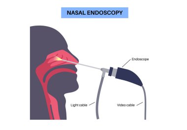 Burun endoskopisi, minimum invaziv tanı prosedürü. Katı endoskop. Burun boşluğu, sinüsler ve nazofarenks muayenesi. Kronik sinüzit, burun polipsi, septum sapması veya tümör düz vektörü.