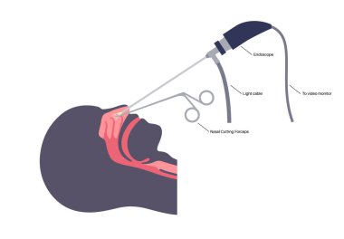 Burun endoskopisi, minimum invaziv tanı prosedürü. Katı endoskop. Burun boşluğu, sinüsler ve nazofarenks muayenesi. Kronik sinüzit, burun polipsi, septum sapması veya tümör düz vektörü.