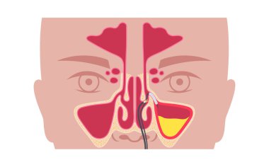 Balon sinüplasti minimal invaziv endoskopik prosedür. Kronik gergedan iltihabı tedavisi. Engellenmiş sinüs kemiğine balon kateteri yerleştirin. Burun tıkanıklığı, yüz ağrısı düz vektör