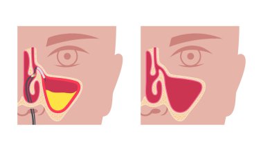 Balon sinüplasti minimal invaziv endoskopik prosedür. Kronik gergedan iltihabı tedavisi. Engellenmiş sinüs kemiğine balon kateteri yerleştirin. Burun tıkanıklığı, yüz ağrısı düz vektör