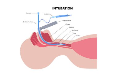 Entübasyon tıbbi prosedürü. Solunum yolunu emniyete almak, havalandırmayı kolaylaştırmak ve oksijen vermek için soluk borusuna bir tüp yerleştirmek. Ses tellerini görselleştirmek için laringoskop kullanıyor.