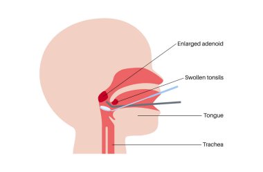 Adenoidektomi ve bademcik ameliyatı. Hipertrofik adenoit ve bademciklerin çıkarılması burun tıkanıklığını, horlamayı ve tekrarlayan enfeksiyonları düz vektör ilüstrasyonunu hafifletir.