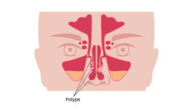 Burun boşluğunda burun polipleri var. İltihaplı mukoza, hava yolu tıkanıklığı ve sinüs anatomisi. Otolaryngology, rinoloji ve ENT eğitimsel kullanımı. Teşhis ve cerrahi tedavi vektörü çizimi