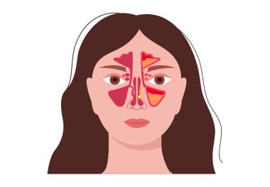 Burun boşluğunda burun polipleri var. İltihaplı mukoza, hava yolu tıkanıklığı ve sinüs anatomisi. Otolaryngology, rinoloji ve ENT eğitimsel kullanımı. Teşhis ve cerrahi tedavi vektörü çizimi