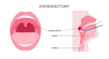 Adenoidektomi pediatrik ENT cerrahi prosedürü. Ağızdan hipertrofik adenoidleri çıkarmak burun tıkanıklığını, horlamayı ve tekrarlayan enfeksiyonları azaltır. Hastanenin ayakta ameliyat vektörü