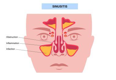 Sinüzit posteri. Paranazal sinüslerin mukozal astarı iltihaplanmış. Viral ya da bakteriyel enfeksiyonlar. Burun tıkanıklığı, yüz basıncı, baş ağrısı, ateş ve gergedan anatomik düz vektör.