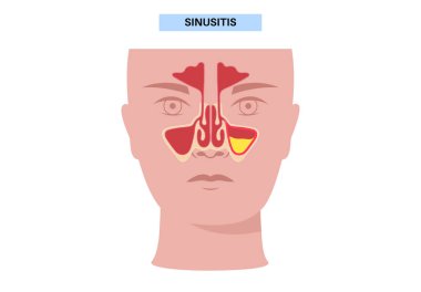Sinüzit posteri. Paranazal sinüslerin mukozal astarı iltihaplanmış. Viral ya da bakteriyel enfeksiyonlar. Burun tıkanıklığı, yüz basıncı, baş ağrısı, ateş ve gergedan anatomik düz vektör.
