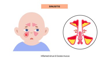 Sinüzit posteri. Paranazal sinüslerin mukozal astarı iltihaplanmış. Viral ya da bakteriyel enfeksiyonlar. Burun tıkanıklığı, yüz basıncı, baş ağrısı, ateş ve gergedan anatomik düz vektör.